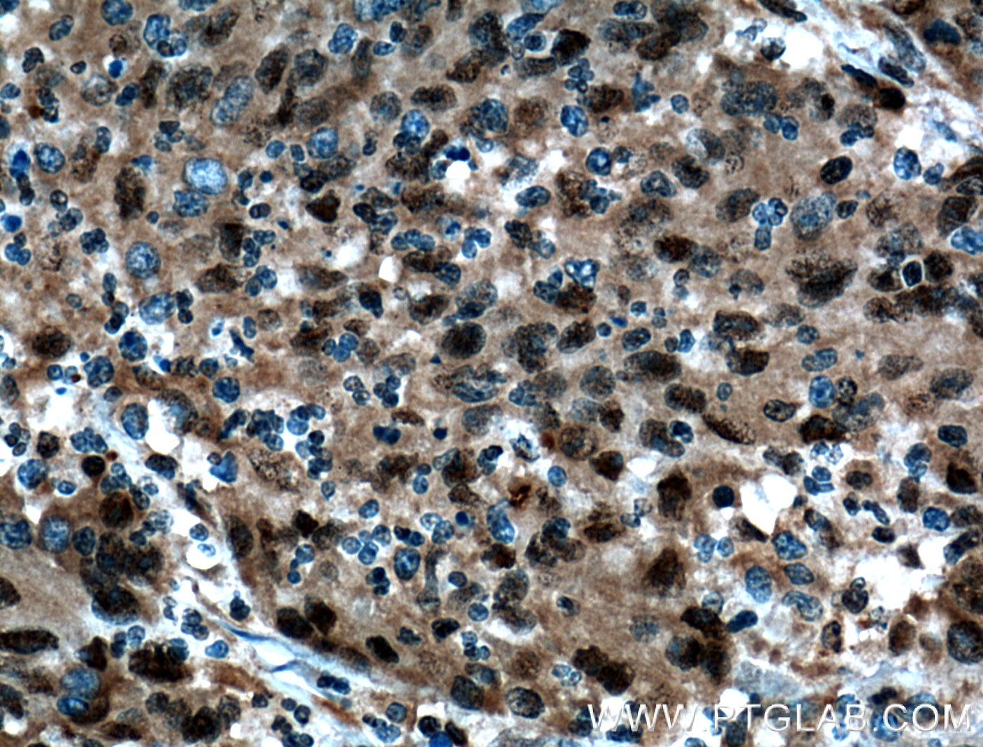 Immunohistochemistry (IHC) staining of human colon cancer tissue using C20orf20 Polyclonal antibody (26040-1-AP)