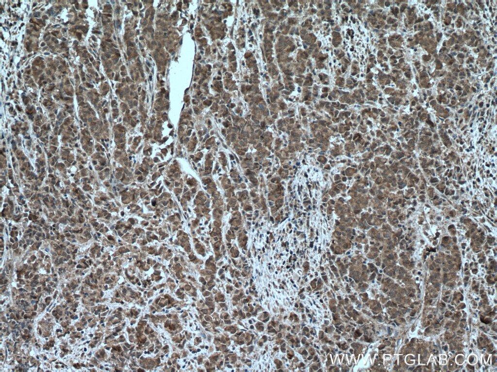 Immunohistochemistry (IHC) staining of human prostate cancer tissue using C20orf201 Polyclonal antibody (26353-1-AP)
