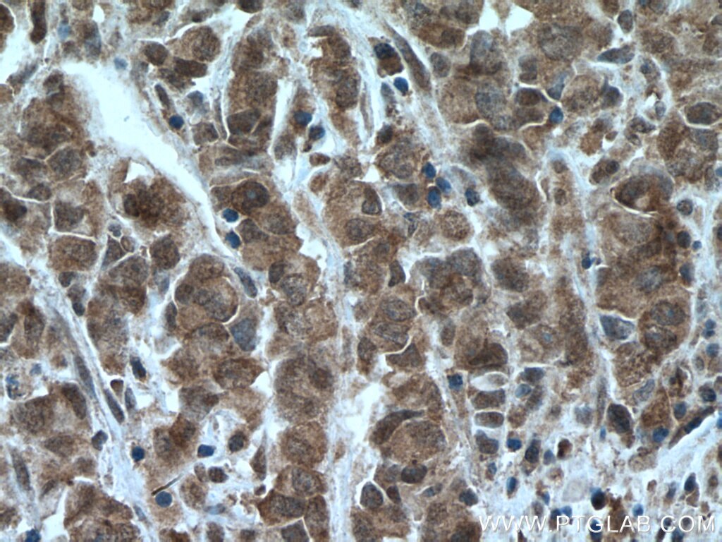 IHC staining of human prostate cancer using 26353-1-AP