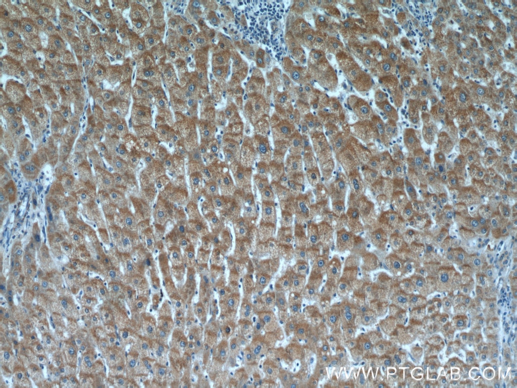 Immunohistochemistry (IHC) staining of human liver cancer tissue using TMEM230 Polyclonal antibody (21466-1-AP)