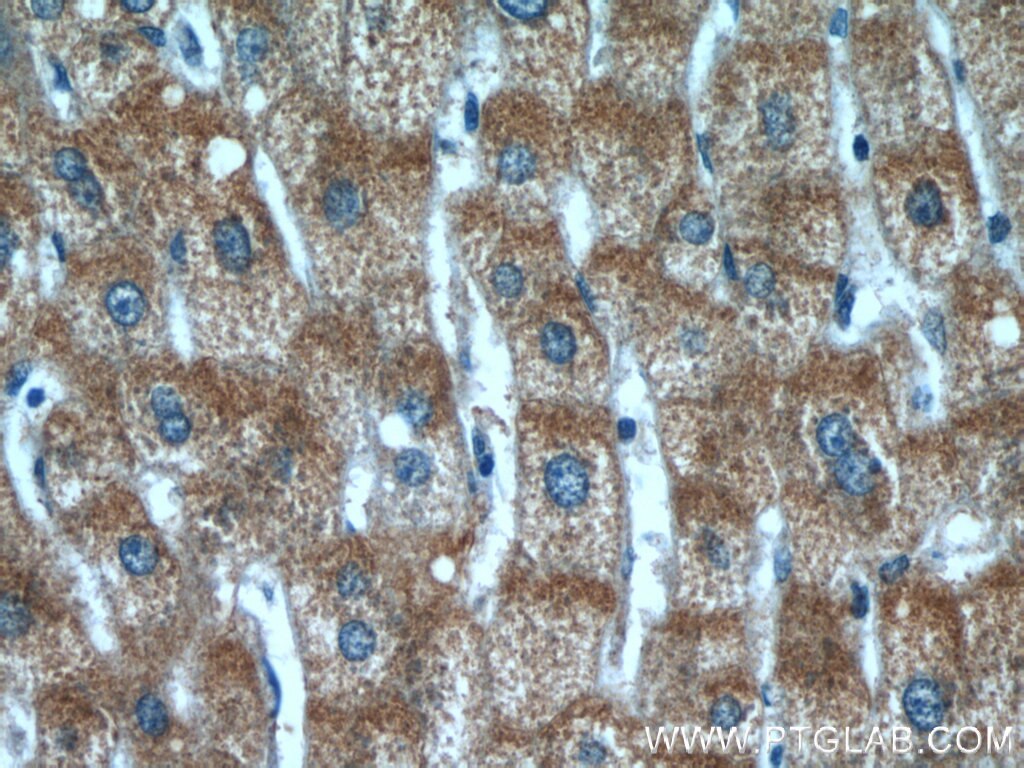 Immunohistochemistry (IHC) staining of human liver cancer tissue using TMEM230 Polyclonal antibody (21466-1-AP)