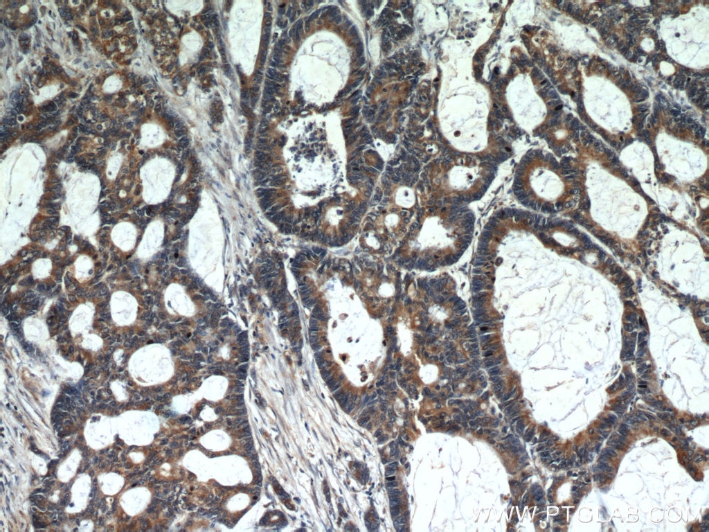 Immunohistochemistry (IHC) staining of human colon cancer tissue using TMEM230 Polyclonal antibody (21466-1-AP)
