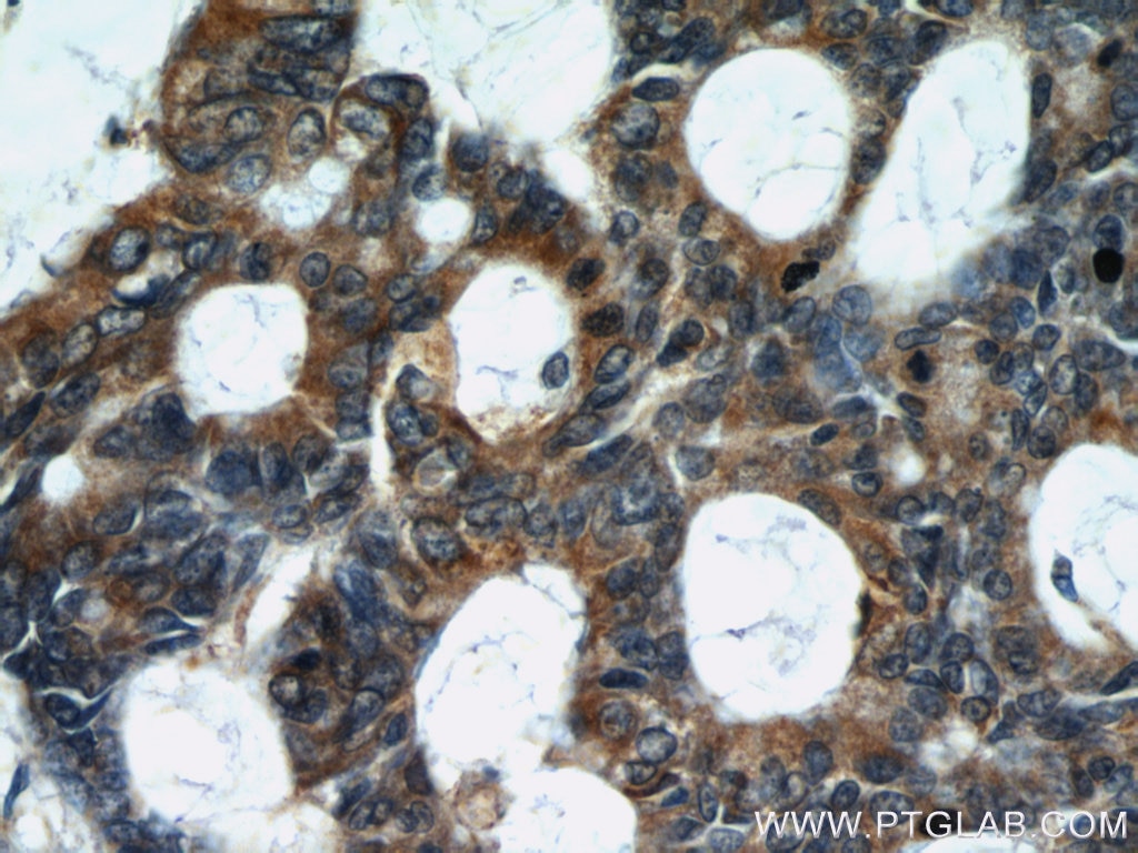 Immunohistochemistry (IHC) staining of human colon cancer tissue using TMEM230 Polyclonal antibody (21466-1-AP)