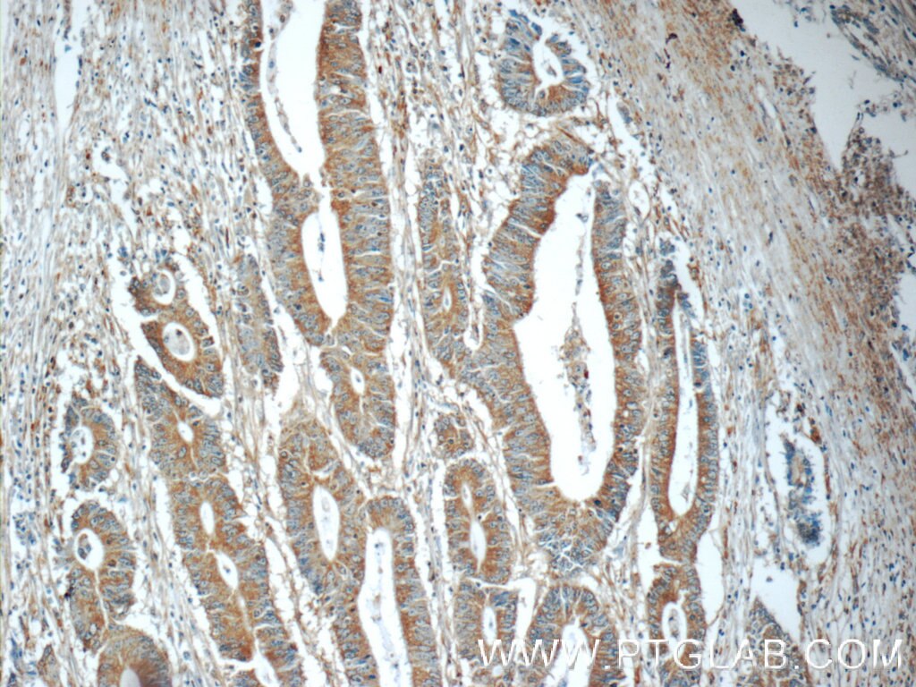 Immunohistochemistry (IHC) staining of human colon cancer tissue using C20orf46 Polyclonal antibody (24678-1-AP)