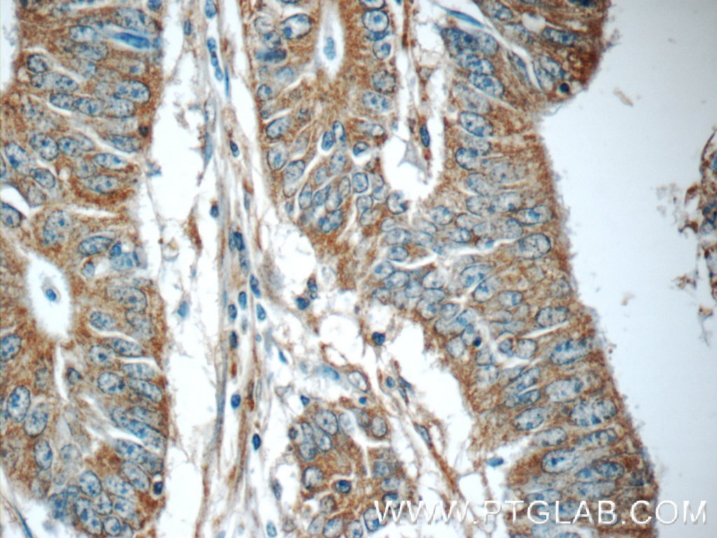 Immunohistochemistry (IHC) staining of human colon cancer tissue using C20orf46 Polyclonal antibody (24678-1-AP)