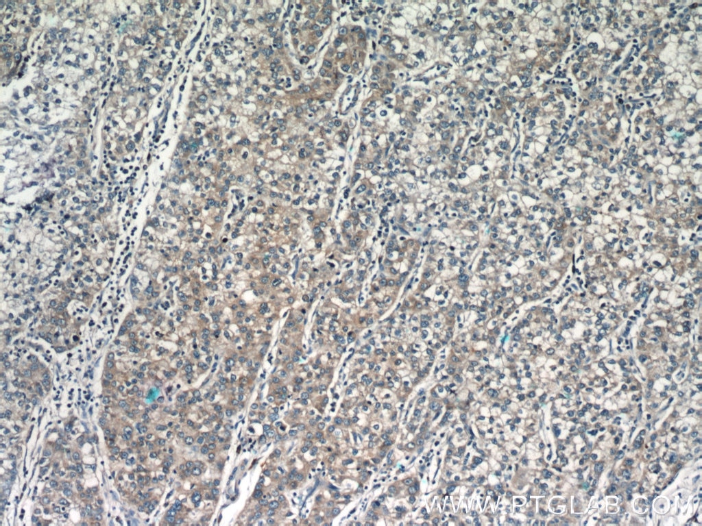 Immunohistochemistry (IHC) staining of human liver cancer tissue using MGME1 Polyclonal antibody (23178-1-AP)