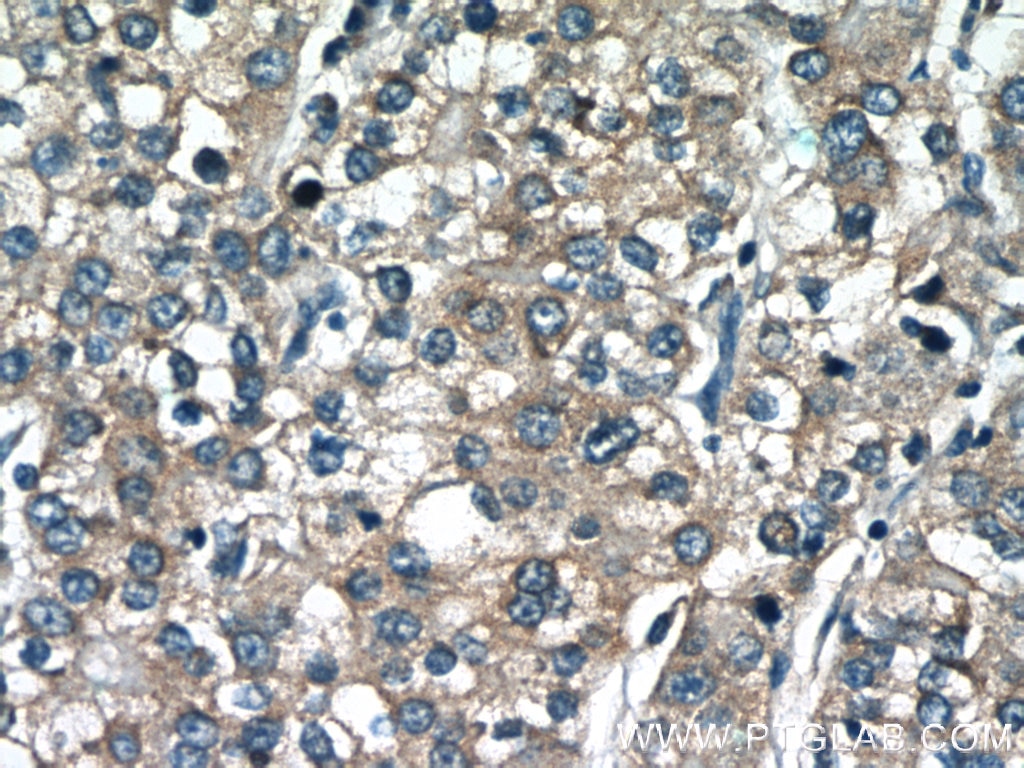 Immunohistochemistry (IHC) staining of human liver cancer tissue using MGME1 Polyclonal antibody (23178-1-AP)