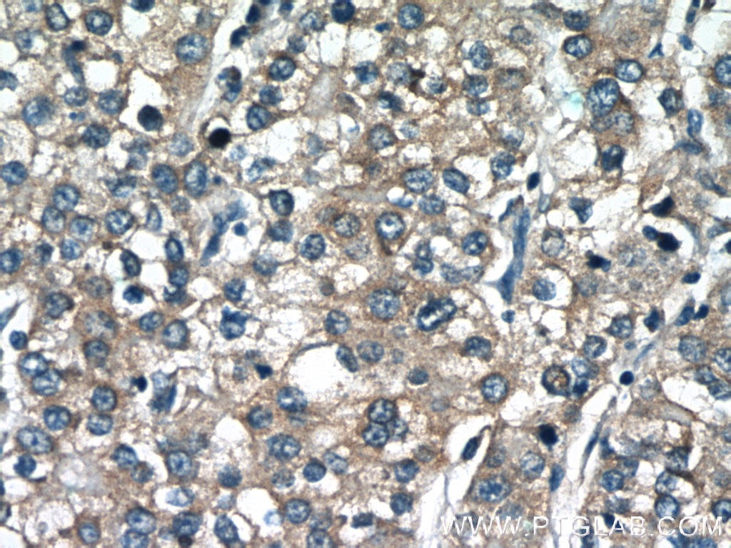 IHC staining of human liver cancer using 23178-1-AP