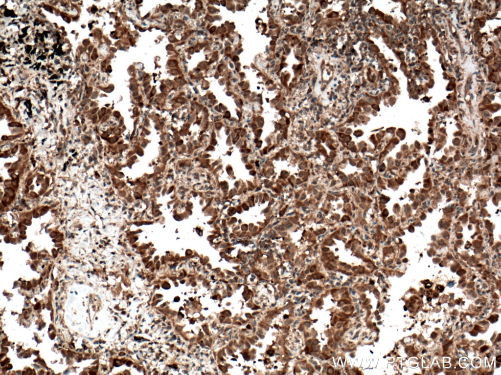 Immunohistochemistry (IHC) staining of human lung cancer tissue using C21orf2 Polyclonal antibody (27609-1-AP)