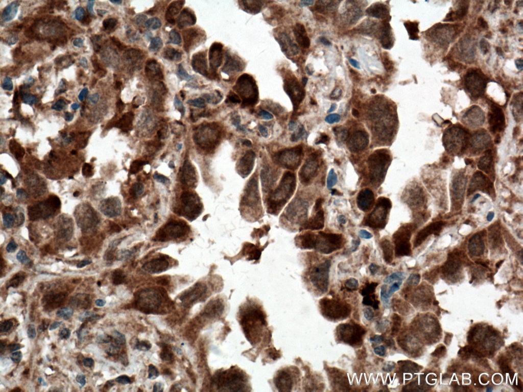 Immunohistochemistry (IHC) staining of human lung cancer tissue using C21orf2 Polyclonal antibody (27609-1-AP)