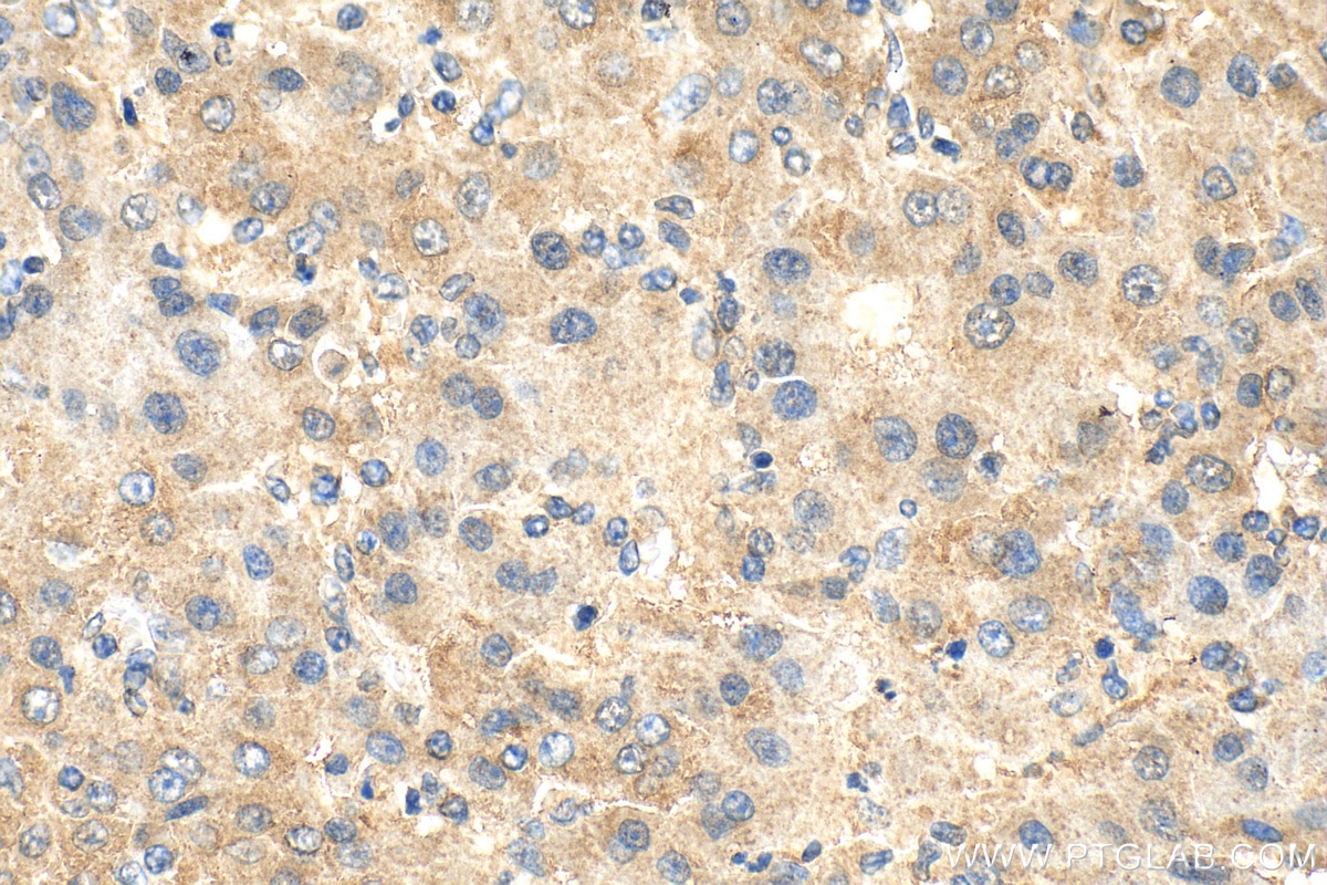 Immunohistochemistry (IHC) staining of human liver cancer tissue using C21orf58 Polyclonal antibody (25024-1-AP)