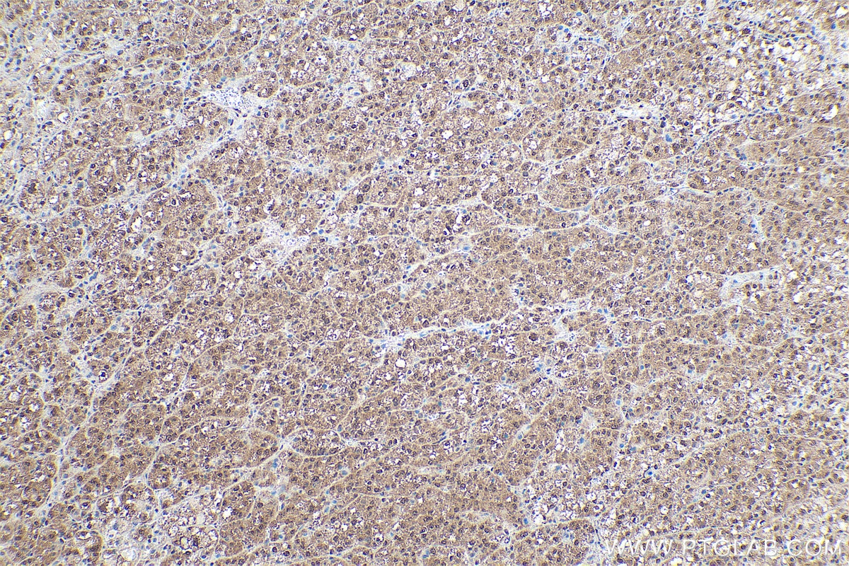 Immunohistochemistry (IHC) staining of human liver cancer tissue using RtcB-Specific Polyclonal antibody (19809-1-AP)