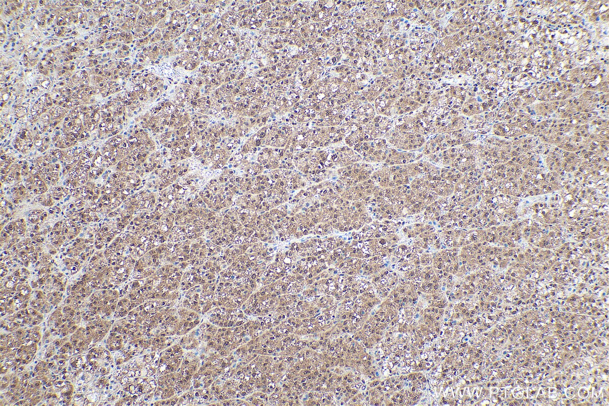 Immunohistochemistry (IHC) staining of human liver cancer tissue using RtcB-Specific Polyclonal antibody (19809-1-AP)