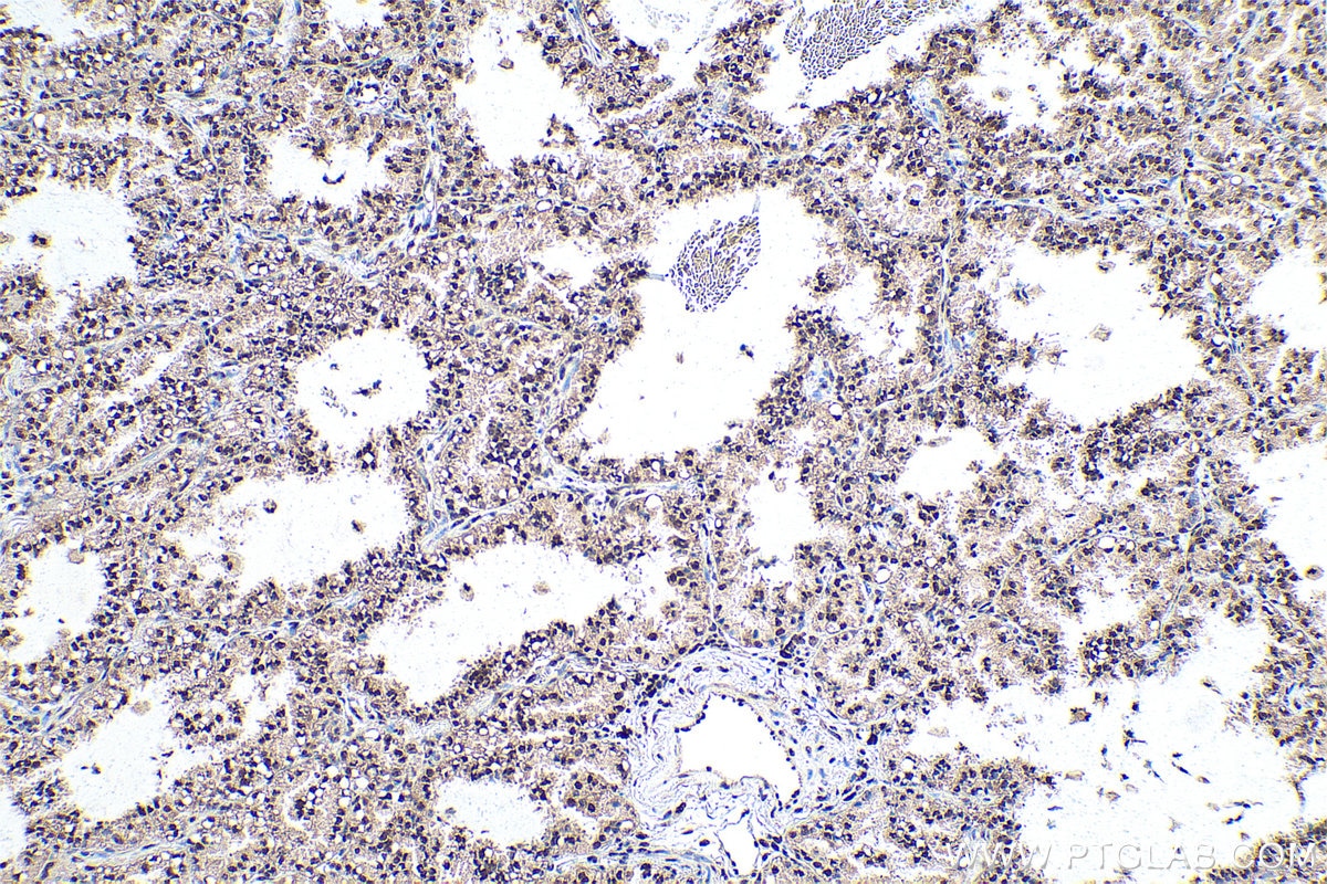 Immunohistochemistry (IHC) staining of human lung cancer tissue using RtcB-Specific Polyclonal antibody (19809-1-AP)