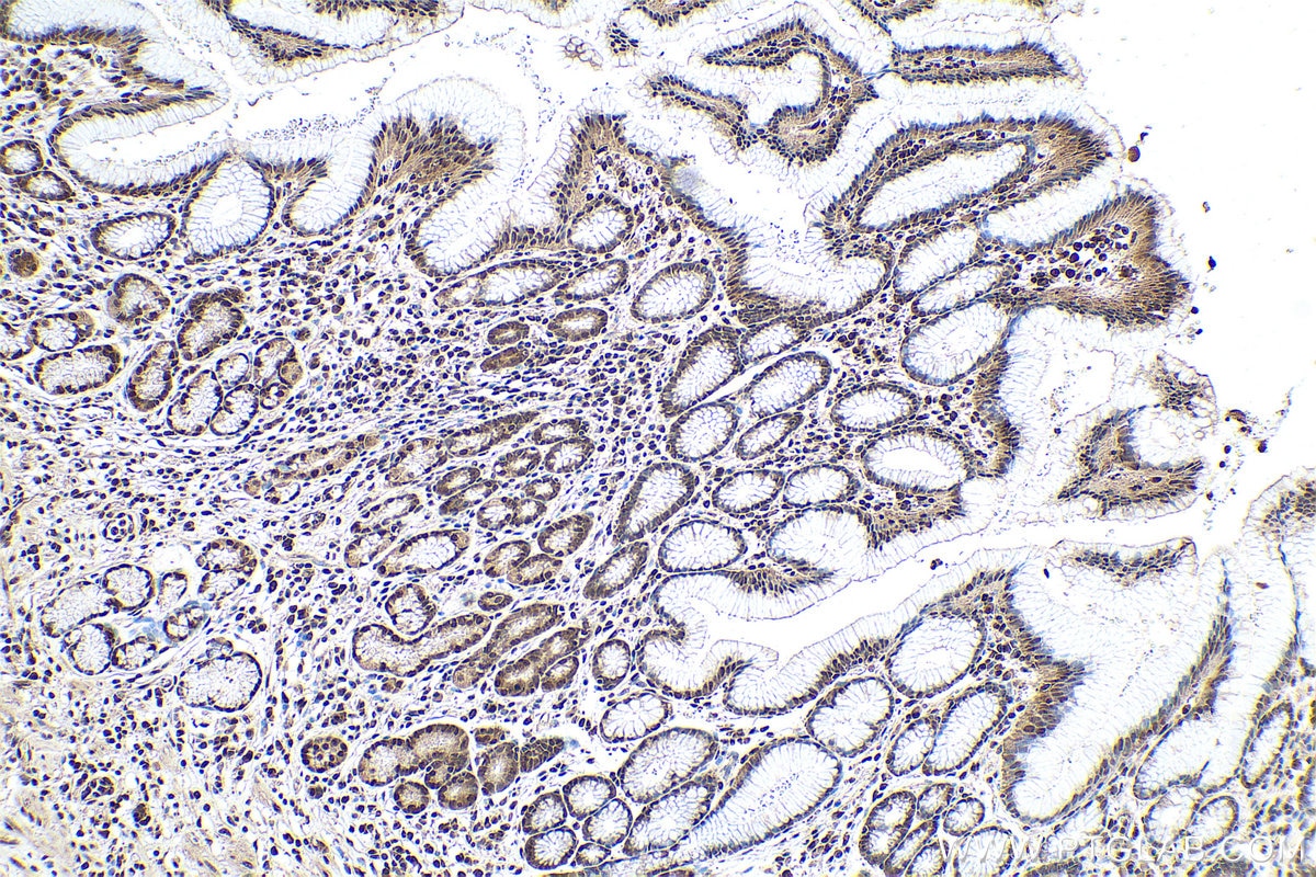 Immunohistochemistry (IHC) staining of human stomach cancer tissue using RtcB-Specific Polyclonal antibody (19809-1-AP)