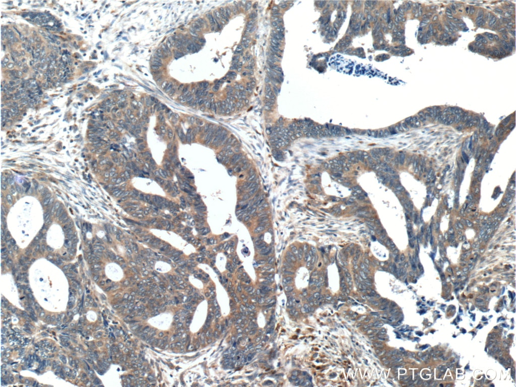 Immunohistochemistry (IHC) staining of human colon cancer tissue using C2orf79/PTRHD1 Polyclonal antibody (25576-1-AP)