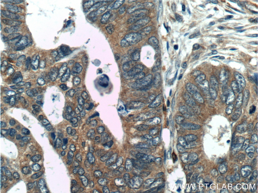 Immunohistochemistry (IHC) staining of human colon cancer tissue using C2orf79/PTRHD1 Polyclonal antibody (25576-1-AP)