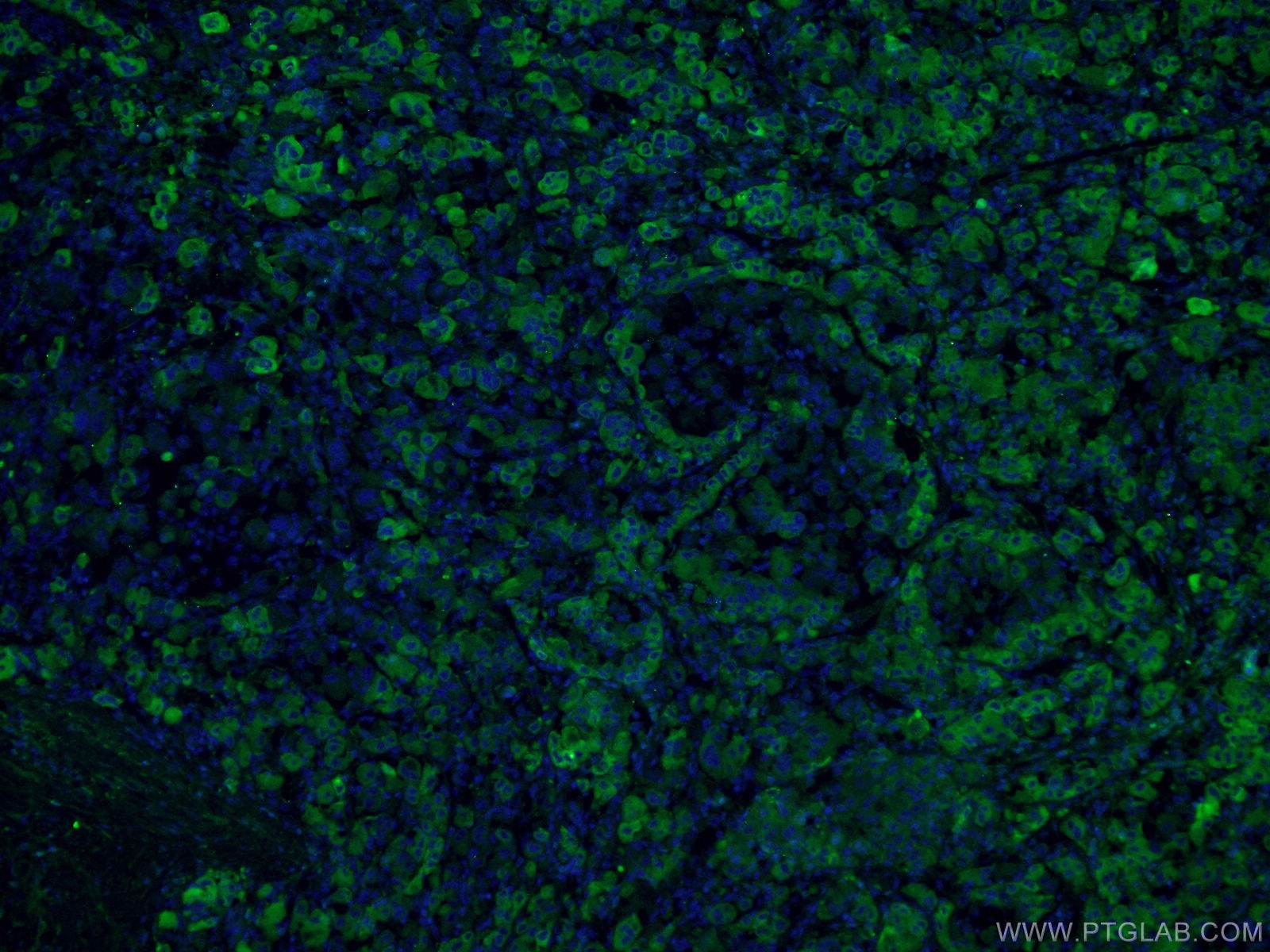 IF Staining of human liver cancer using 21337-1-AP