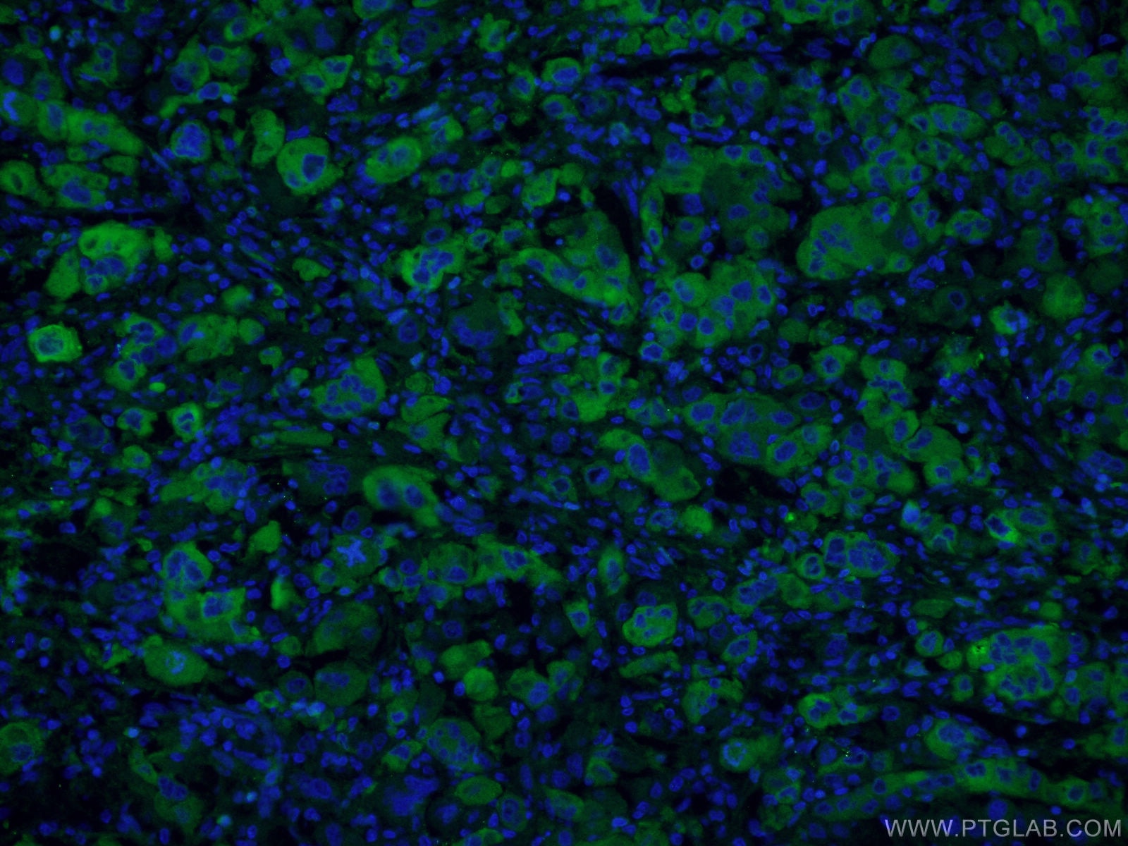 IF Staining of human liver cancer using 21337-1-AP