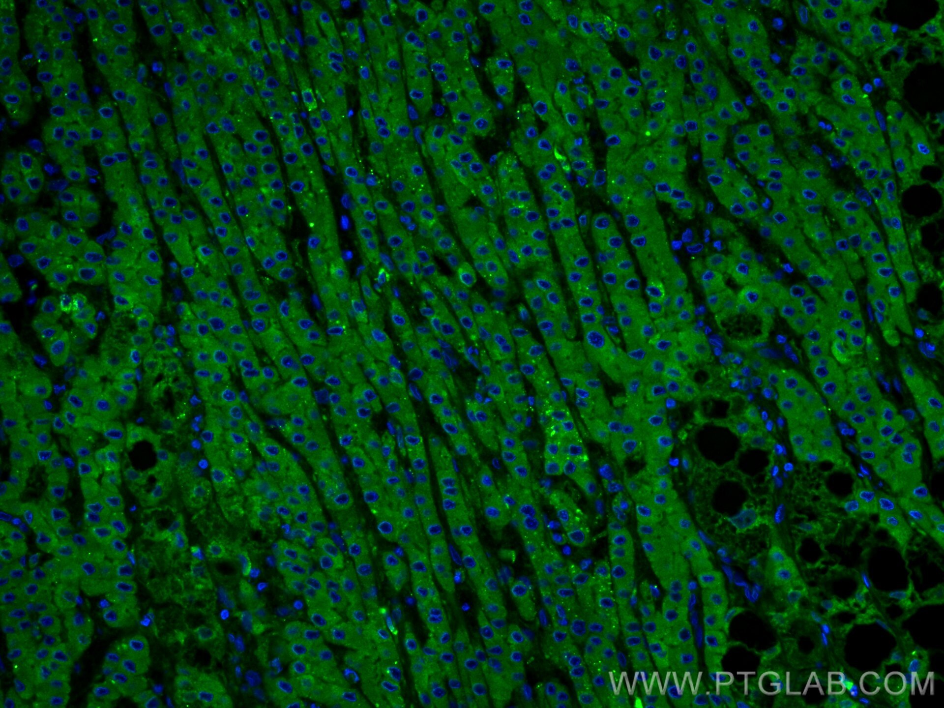 Immunofluorescence (IF) / fluorescent staining of human liver cancer tissue using C3/C3b/C3c Polyclonal antibody (21337-1-AP)