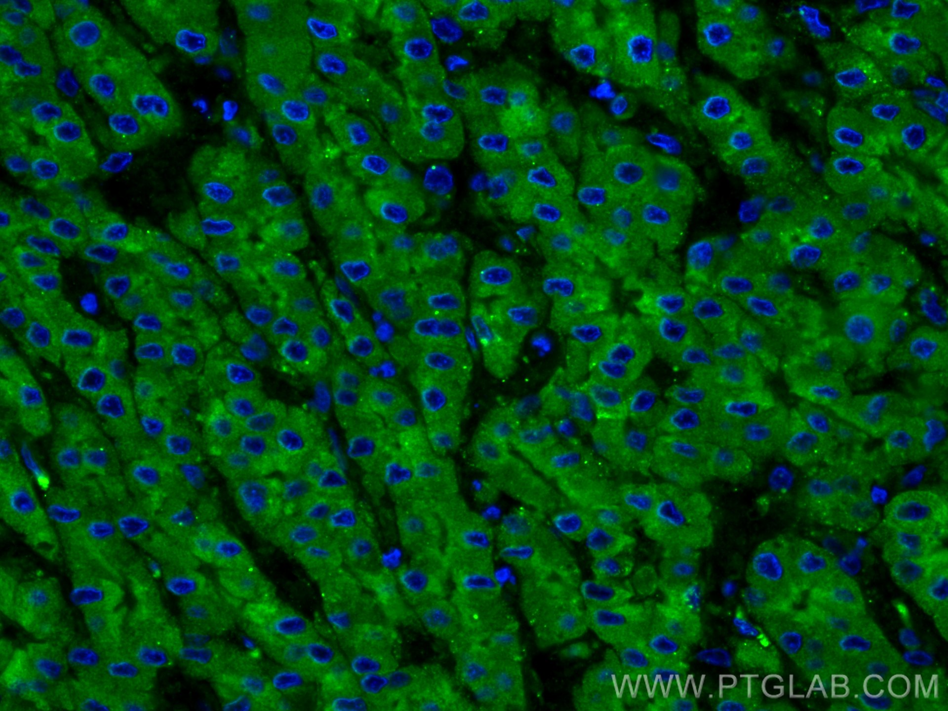 Immunofluorescence (IF) / fluorescent staining of human liver cancer tissue using C3/C3b/C3c Polyclonal antibody (21337-1-AP)