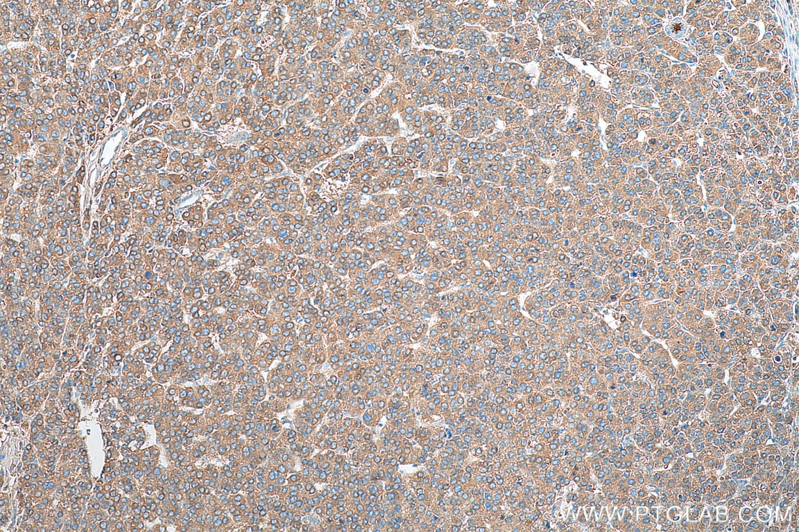 IHC staining of human liver cancer using 21337-1-AP