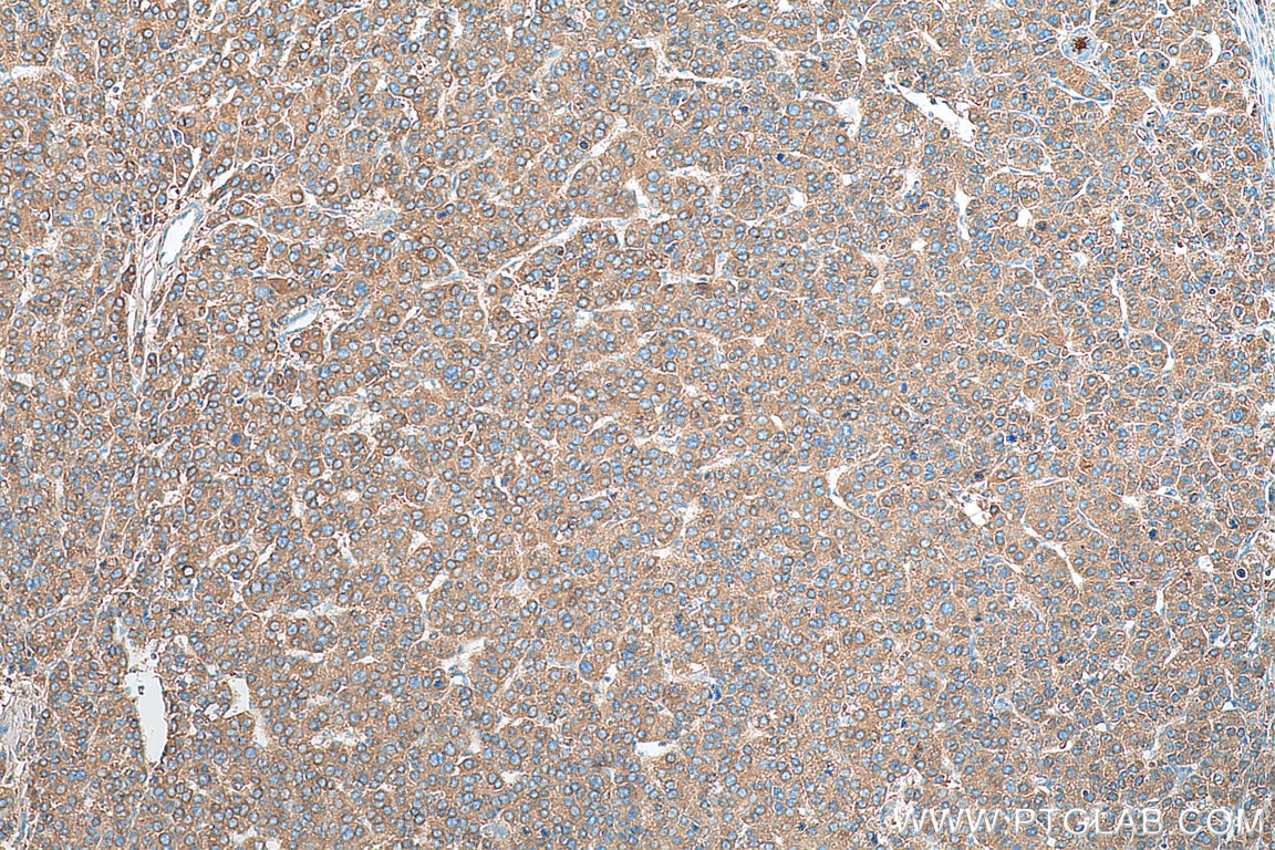 Immunohistochemistry (IHC) staining of human liver cancer tissue using C3/C3b/C3c Polyclonal antibody (21337-1-AP)