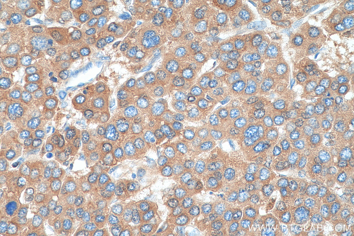 Immunohistochemistry (IHC) staining of human liver cancer tissue using C3/C3b/C3c Polyclonal antibody (21337-1-AP)