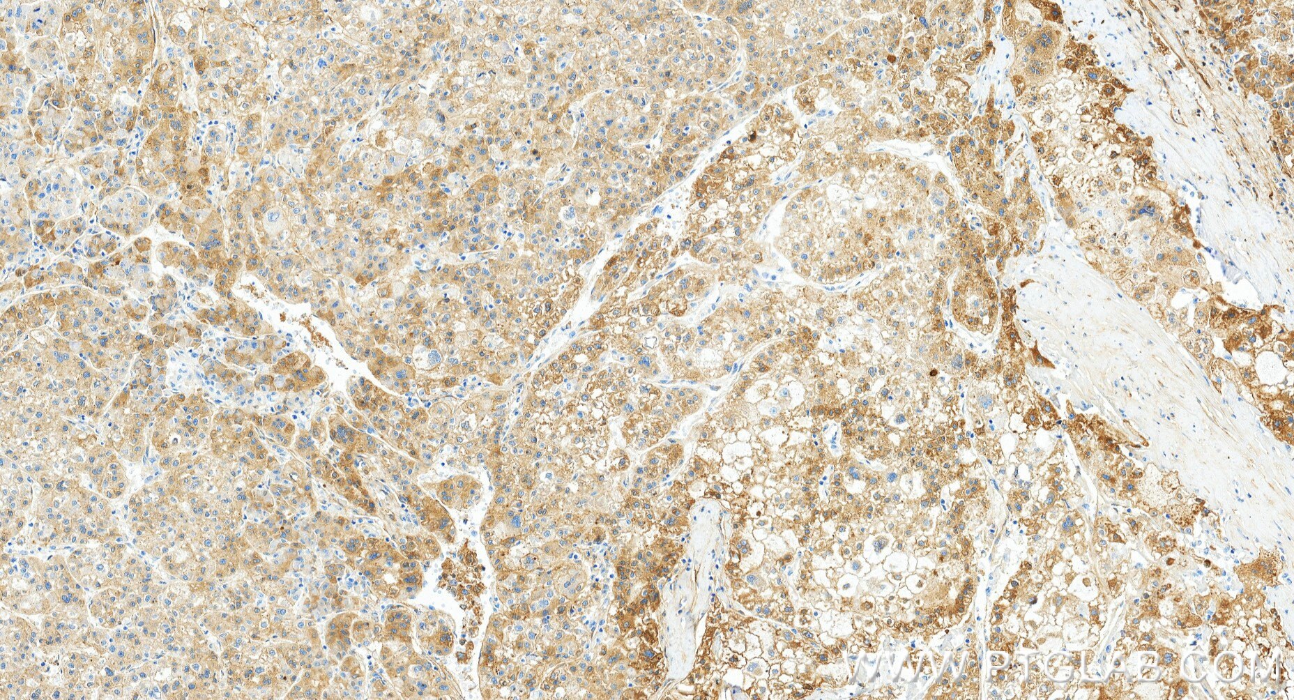 IHC staining of human liver cancer using 87386-1-RR Immunohistochemistry (IHC) staining of human liver cancer tissue using C3 Recombinant monoclonal antibody (87386-1-RR)