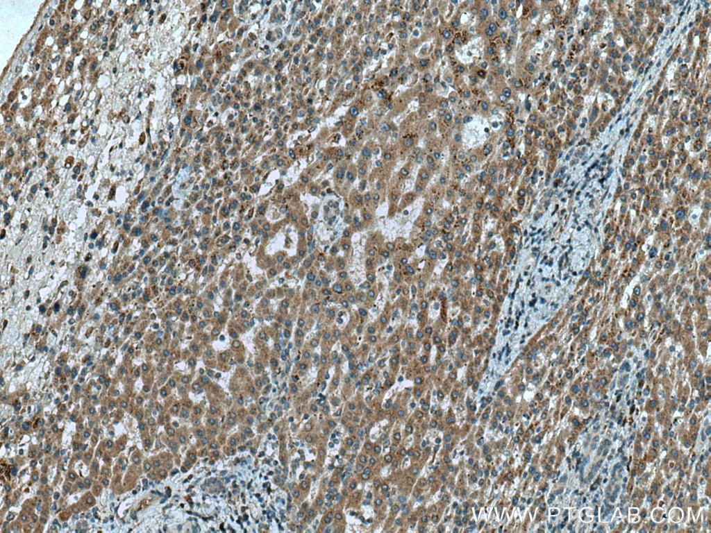 Immunohistochemistry (IHC) staining of human liver cancer tissue using C3orf10 Polyclonal antibody (22157-1-AP)