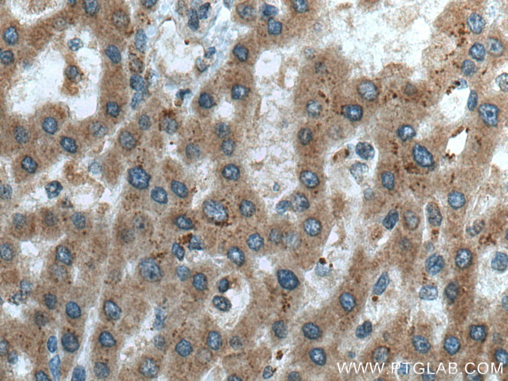 Immunohistochemistry (IHC) staining of human liver cancer tissue using C3orf10 Polyclonal antibody (22157-1-AP)