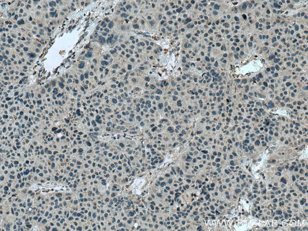 Immunohistochemistry (IHC) staining of human liver cancer tissue using C3orf10 Polyclonal antibody (22157-1-AP)
