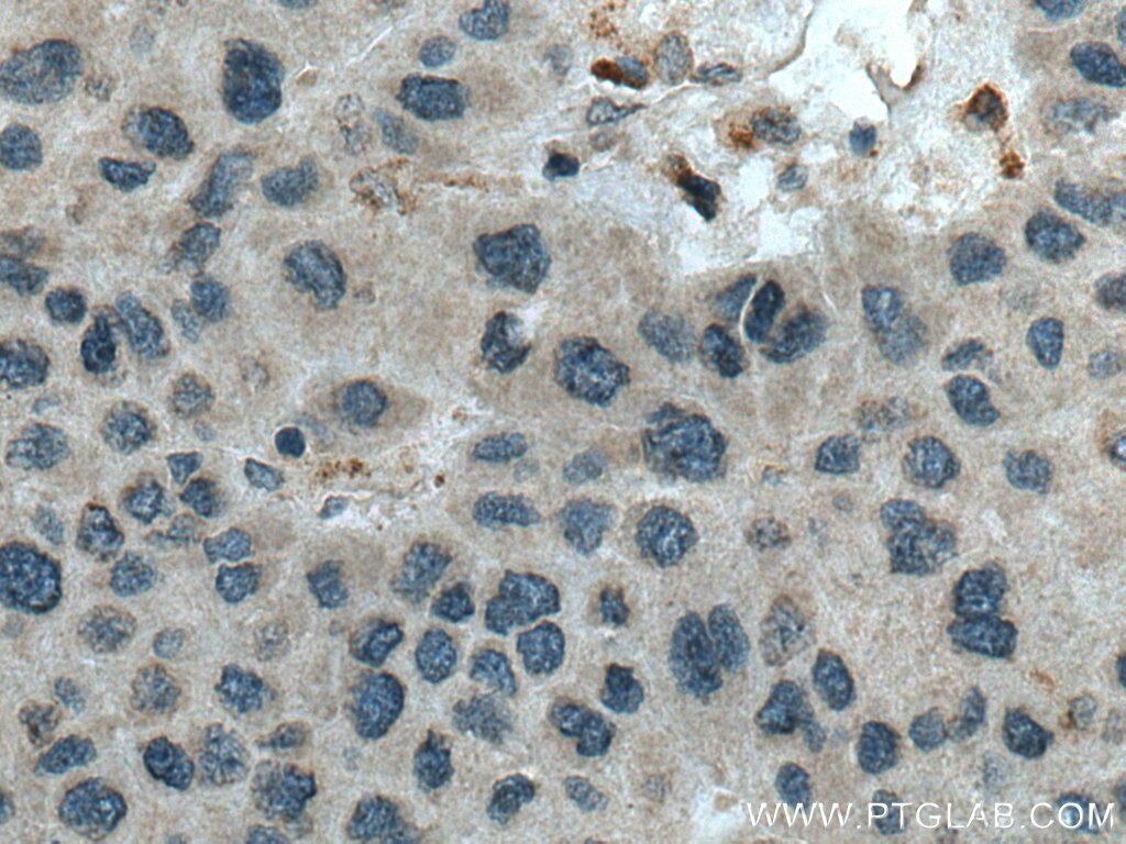 Immunohistochemistry (IHC) staining of human liver cancer tissue using C3orf10 Polyclonal antibody (22157-1-AP)