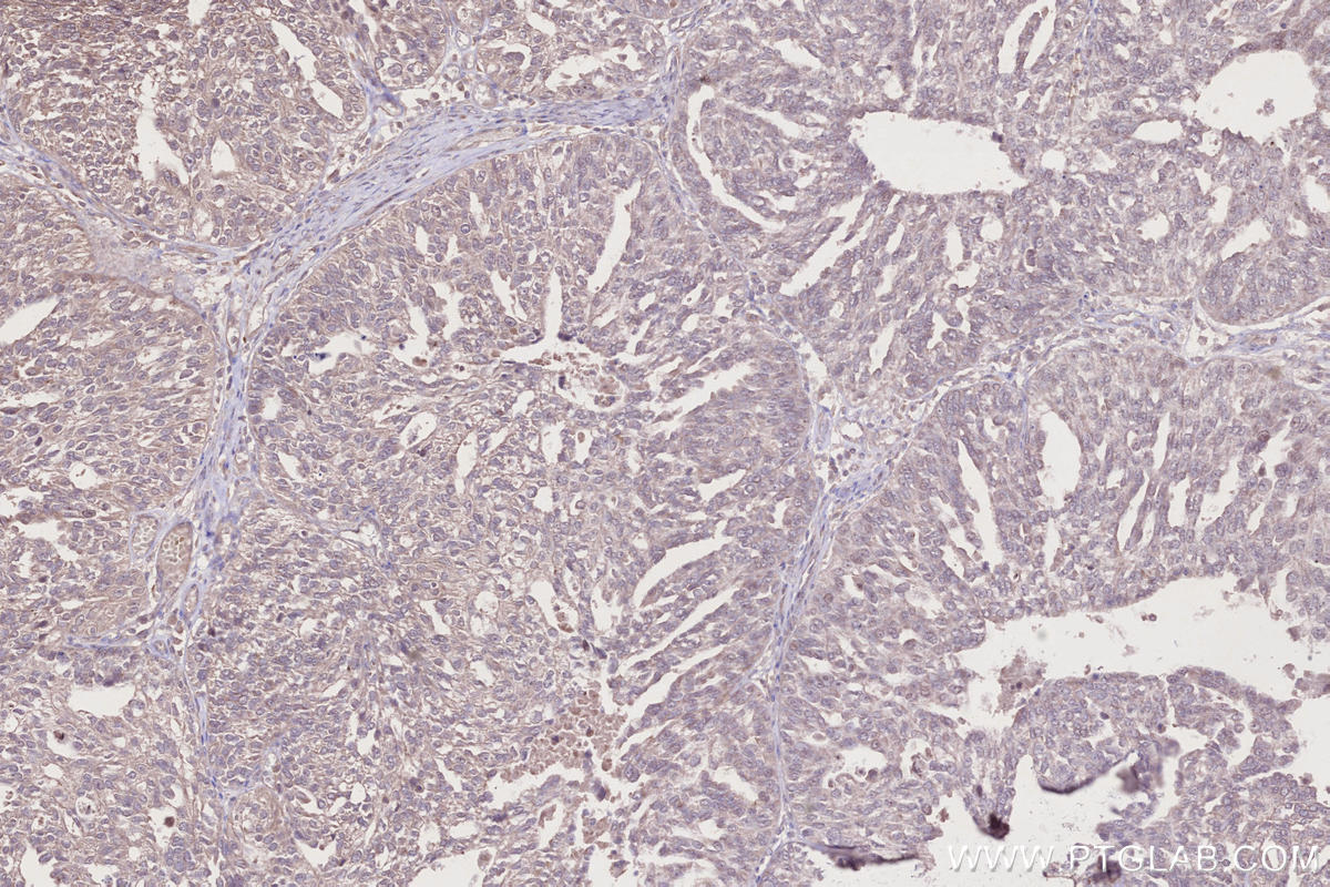 Immunohistochemistry (IHC) staining of human ovary cancer tissue using C3orf10 Polyclonal antibody (22157-1-AP)