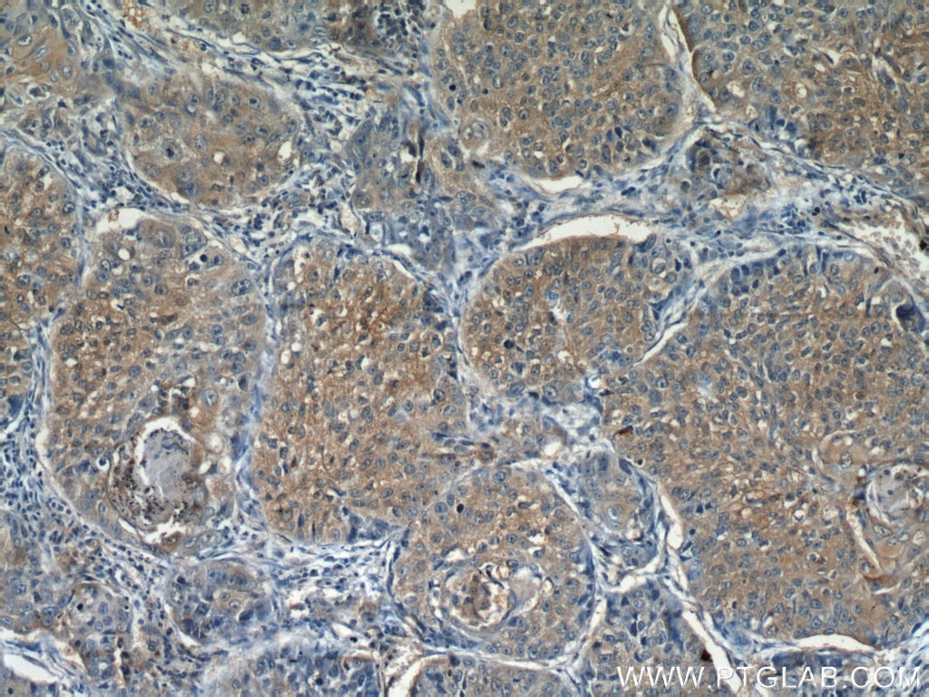 Immunohistochemistry (IHC) staining of human lung cancer tissue using C3orf10 Polyclonal antibody (22157-1-AP)