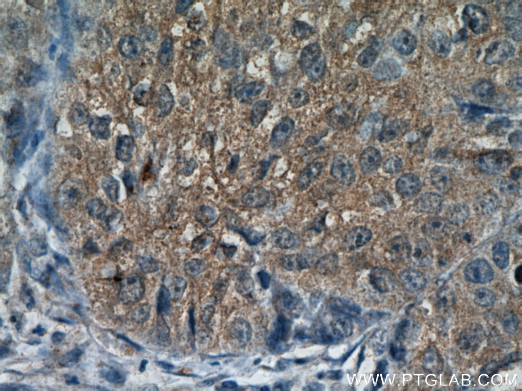 IHC staining of human lung cancer using 22157-1-AP