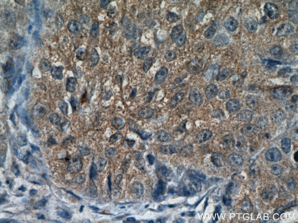 Immunohistochemistry (IHC) staining of human lung cancer tissue using C3orf10 Polyclonal antibody (22157-1-AP)