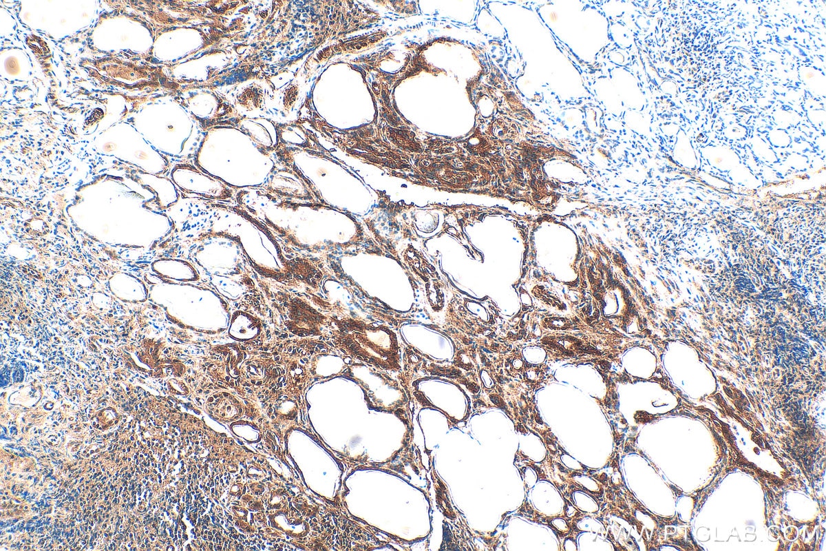 Immunohistochemistry (IHC) staining of human thyroid cancer tissue using C3orf20 Recombinant monoclonal antibody (84975-1-RR)
