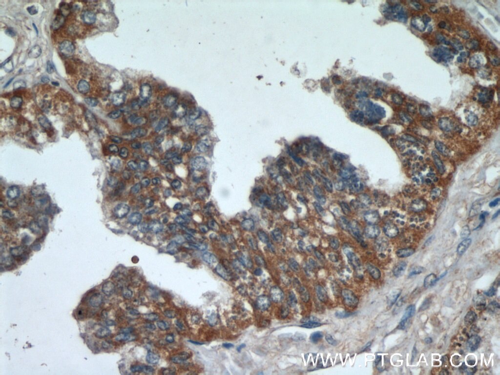 Immunohistochemistry (IHC) staining of human prostate hyperplasia tissue using C3orf21 Polyclonal antibody (20913-1-AP)