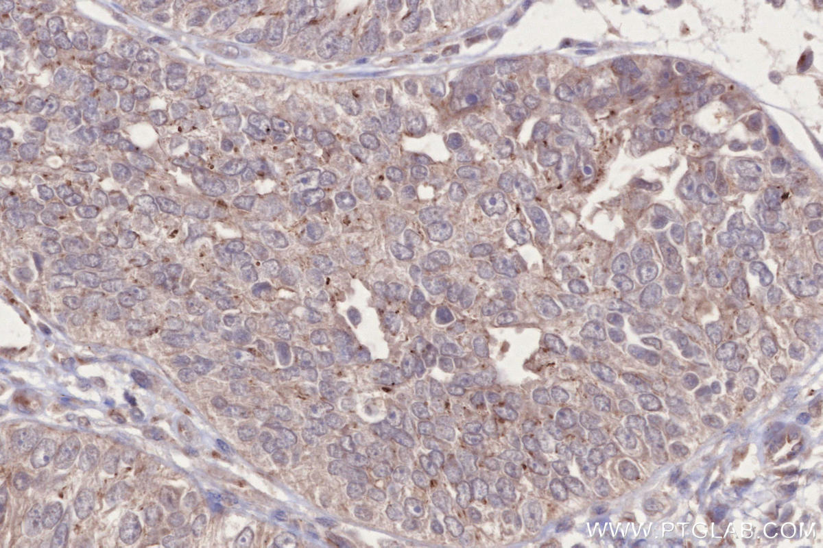 Immunohistochemistry (IHC) staining of human ovary cancer tissue using C3orf58 Polyclonal antibody (27145-1-AP)