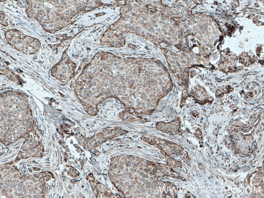 Immunohistochemistry (IHC) staining of human breast cancer tissue using C3orf64 Polyclonal antibody (27595-1-AP)