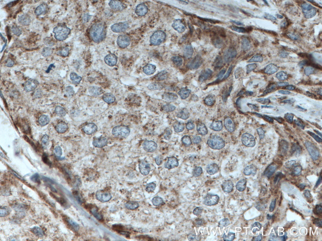 Immunohistochemistry (IHC) staining of human breast cancer tissue using C3orf64 Polyclonal antibody (27595-1-AP)