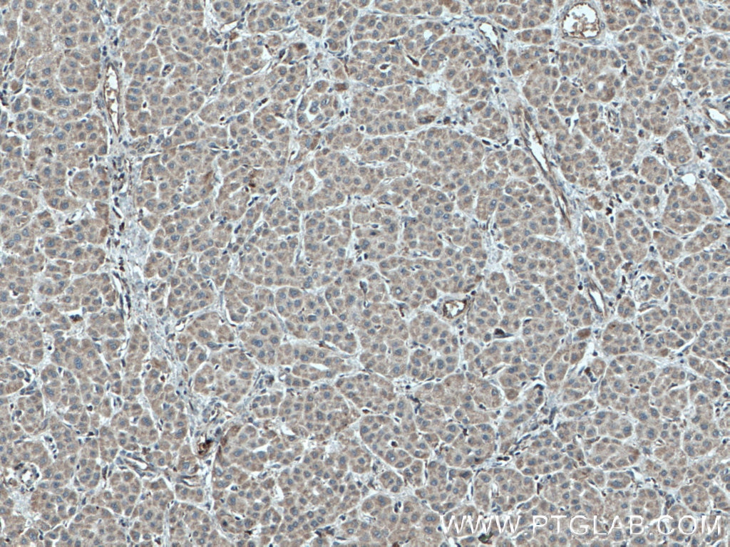 IHC staining of human liver cancer using 27595-1-AP