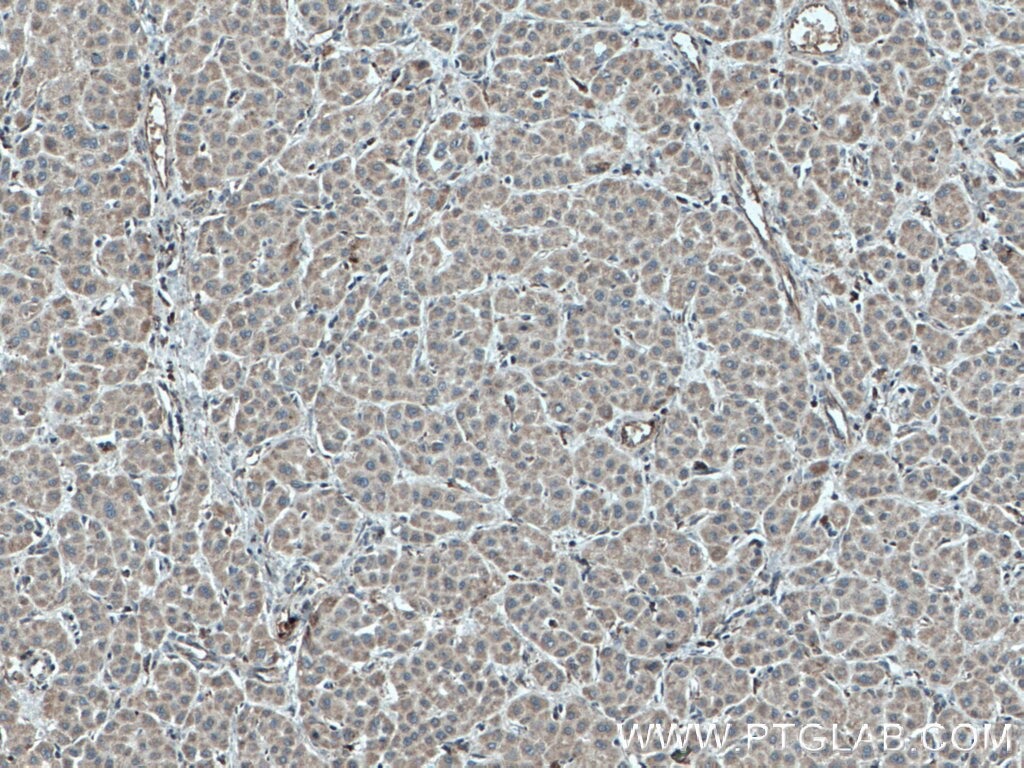 Immunohistochemistry (IHC) staining of human liver cancer tissue using C3orf64 Polyclonal antibody (27595-1-AP)