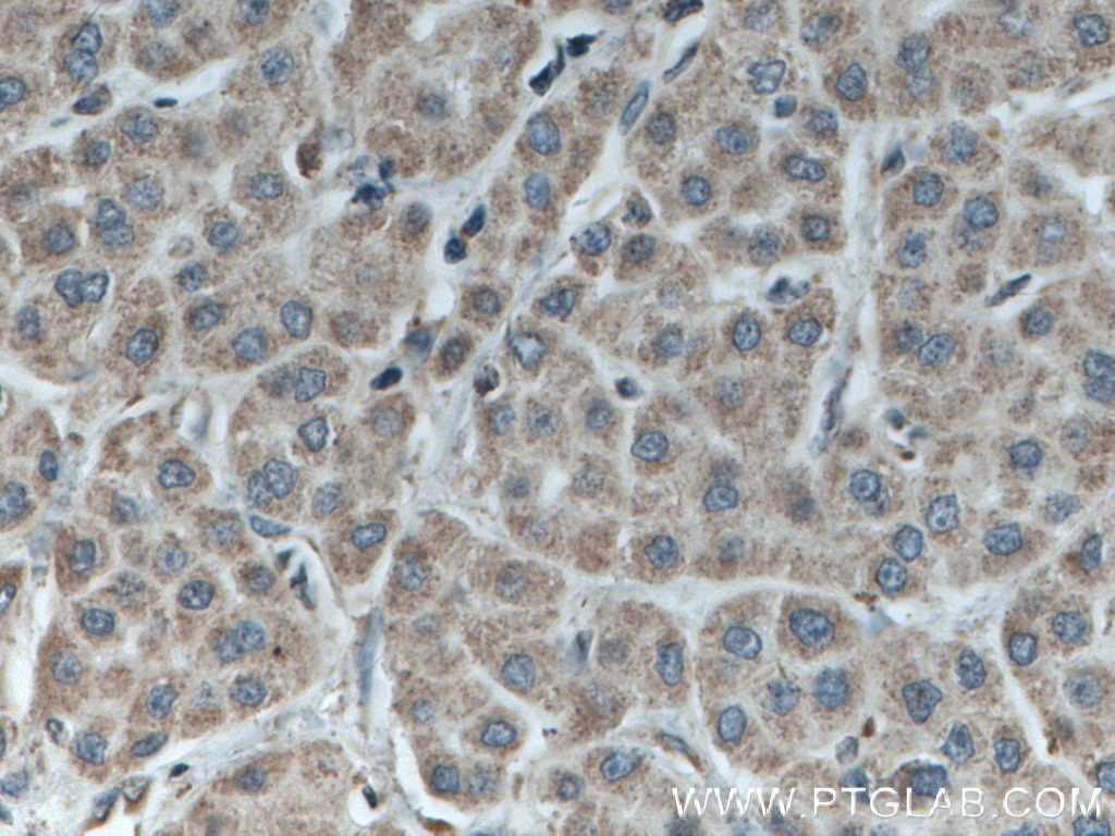 Immunohistochemistry (IHC) staining of human liver cancer tissue using C3orf64 Polyclonal antibody (27595-1-AP)
