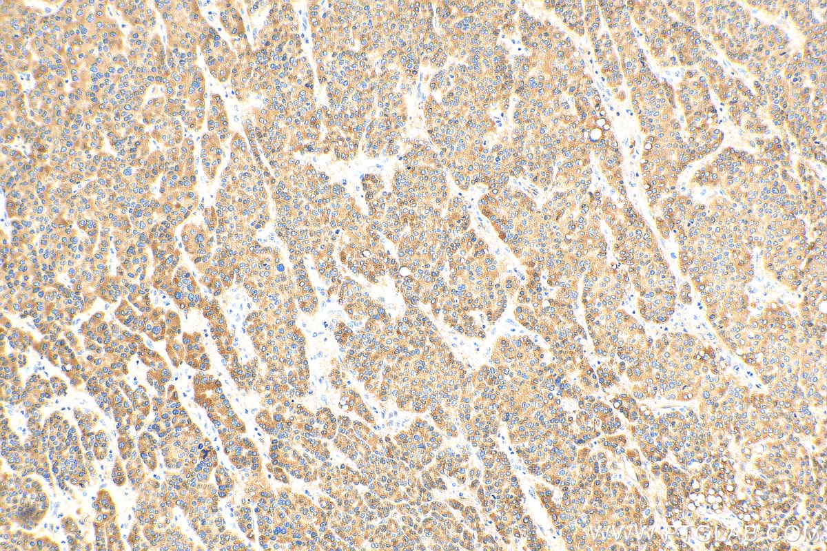 Immunohistochemistry (IHC) staining of human liver cancer tissue using C4 Gamma Chain Polyclonal antibody (17160-1-AP)