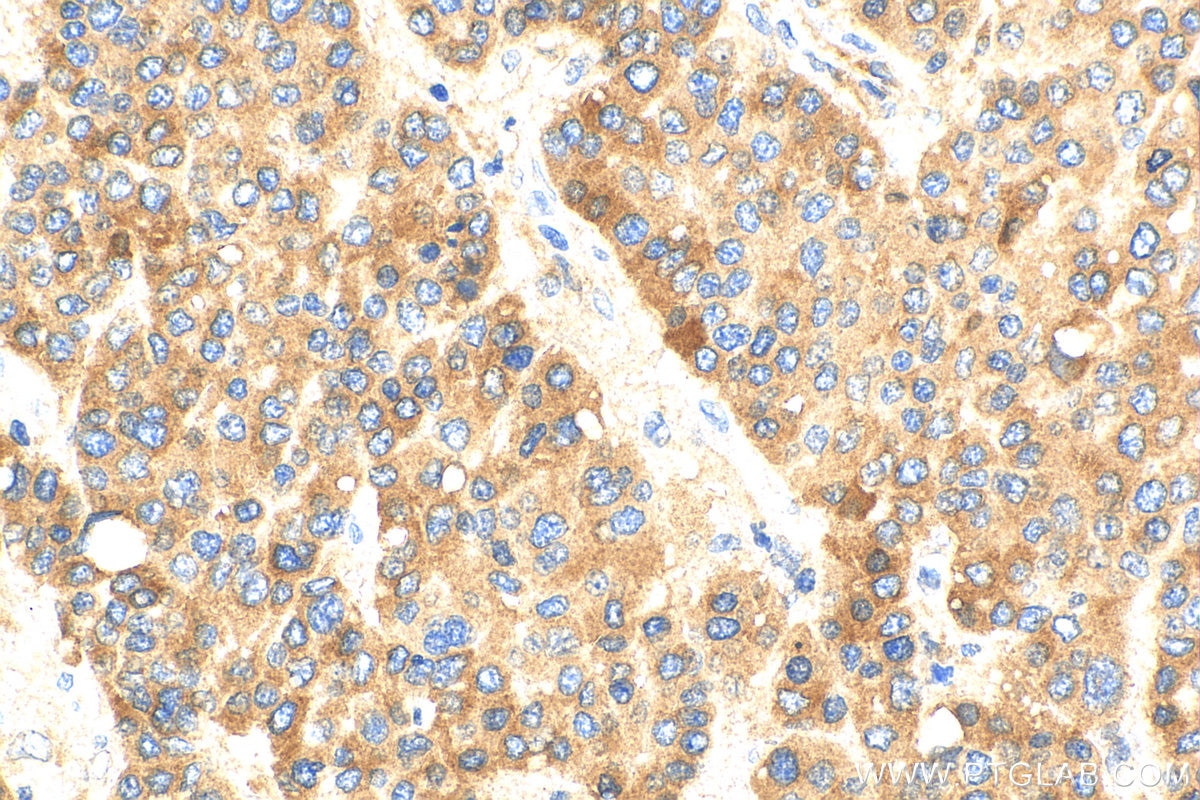 Immunohistochemistry (IHC) staining of human liver cancer tissue using C4 Gamma Chain Polyclonal antibody (17160-1-AP)