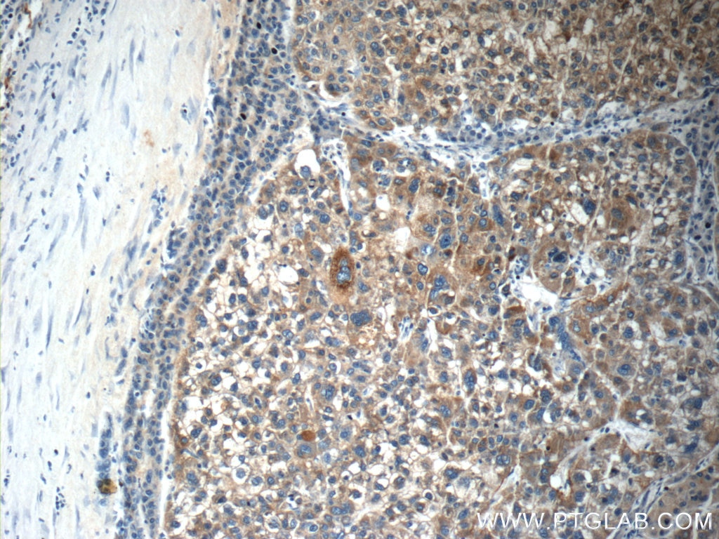 Immunohistochemistry (IHC) staining of human liver cancer tissue using C4BPA Polyclonal antibody (11819-1-AP)