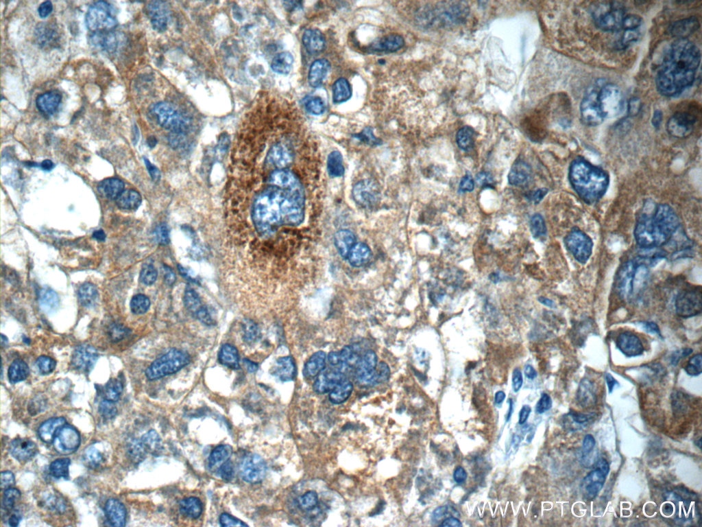 Immunohistochemistry (IHC) staining of human liver cancer tissue using C4BPA Polyclonal antibody (11819-1-AP)