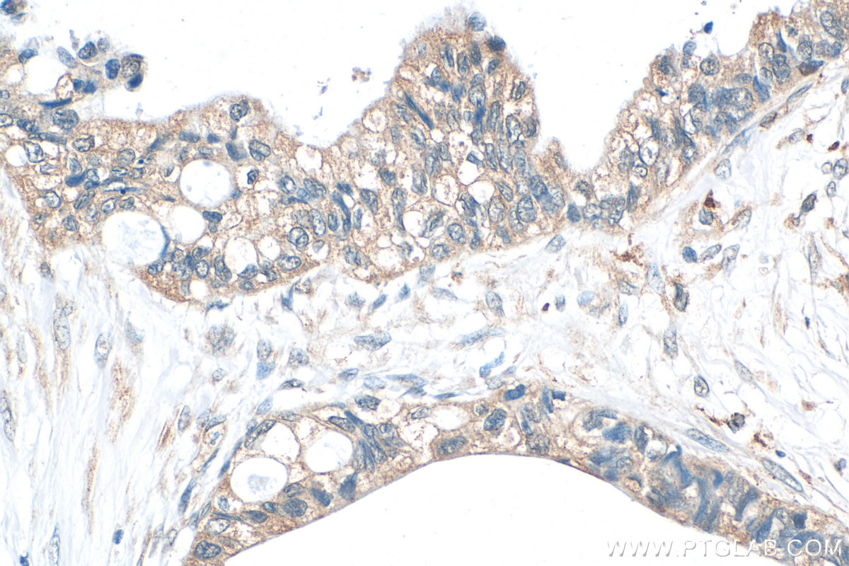 Immunohistochemical analysis of paraffin-embedded human urothelial carcinoma tissue slide using 18991-1-AP (HAUS3 antibody) at dilution of 1:200 (under 40x lens). Heat mediated antigen retrieval with Tris-EDTA buffer (pH 9.0). Immunohistochemistry (IHC) staining of human urothelial carcinoma tissue using HAUS3 Polyclonal antibody (18991-1-AP)